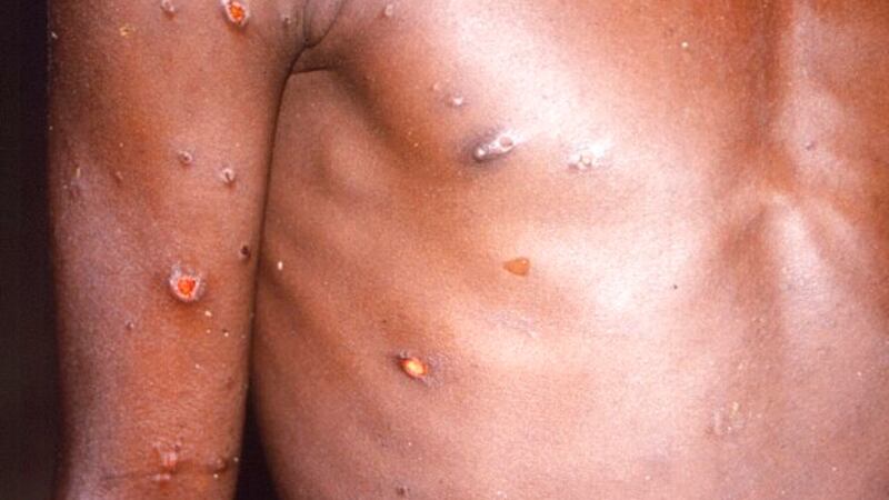 This 1997 image provided by CDC, shows the right arm and torso of a patient, whose skin...